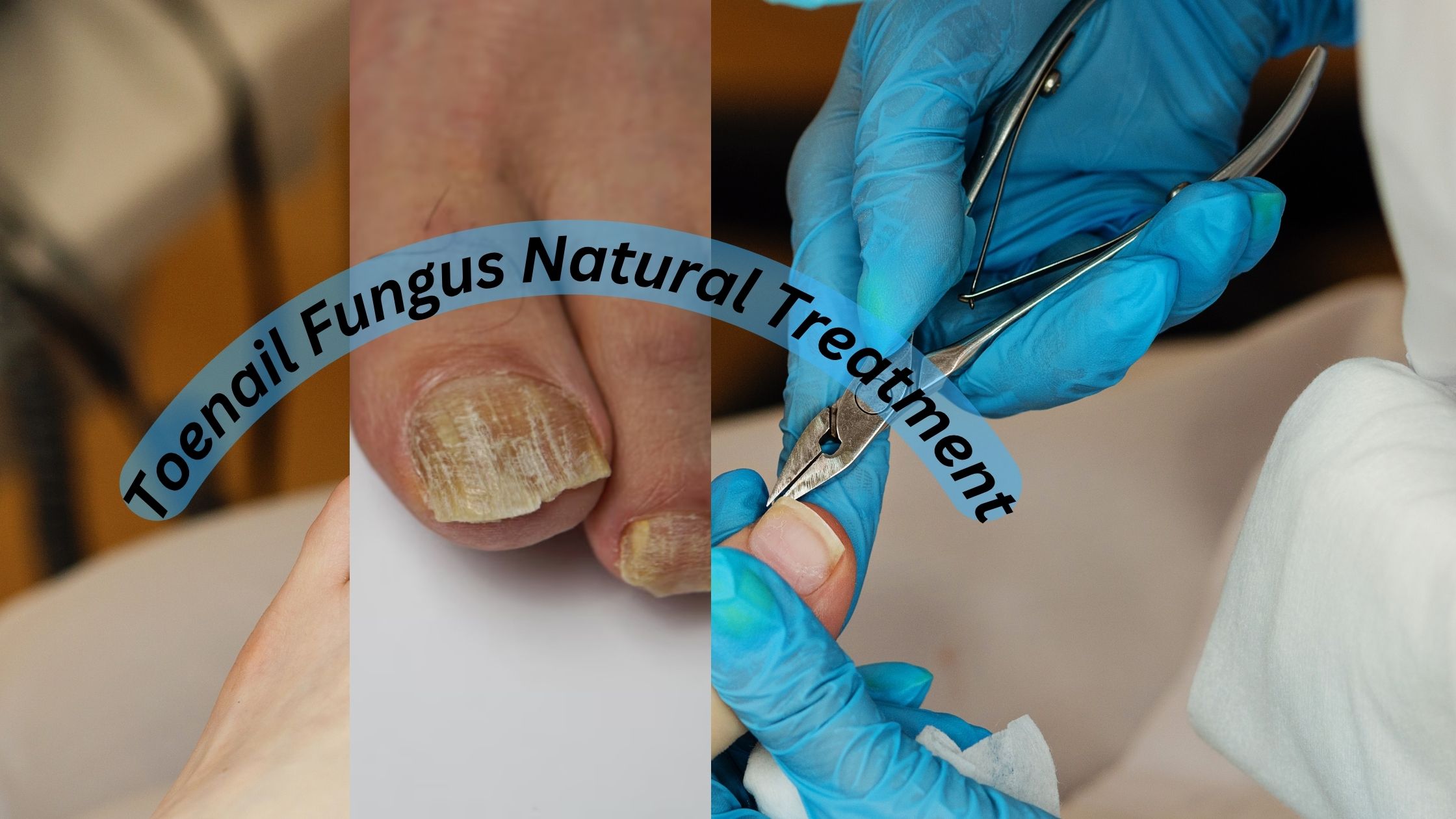 Toenail Fungus Natural Treatment: A Comprehensive Guide