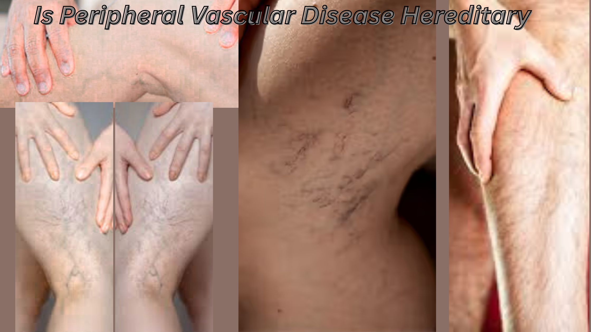 Is Peripheral Vascular Disease Hereditary? – Elite Vascular
