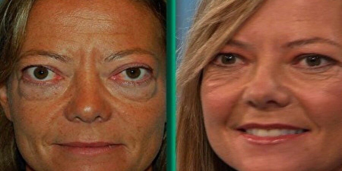 Thyroid Eye Disease (TED) Market is driven by Innovative Therapies