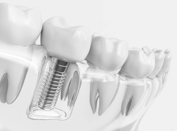 Dental Implants in Fort Worth | Texas Sedation Dental