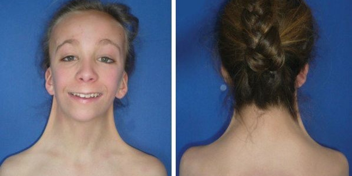 Turner Syndrome Market is Driven by Innovative Therapeutics