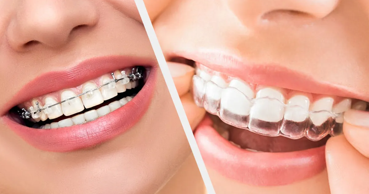 Expert Orthodontist in RR Nagar