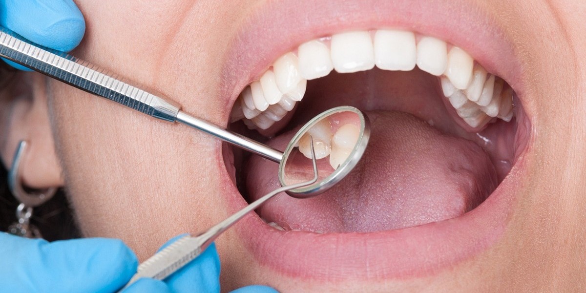 Managing Anxiety Before a Dental Extraction