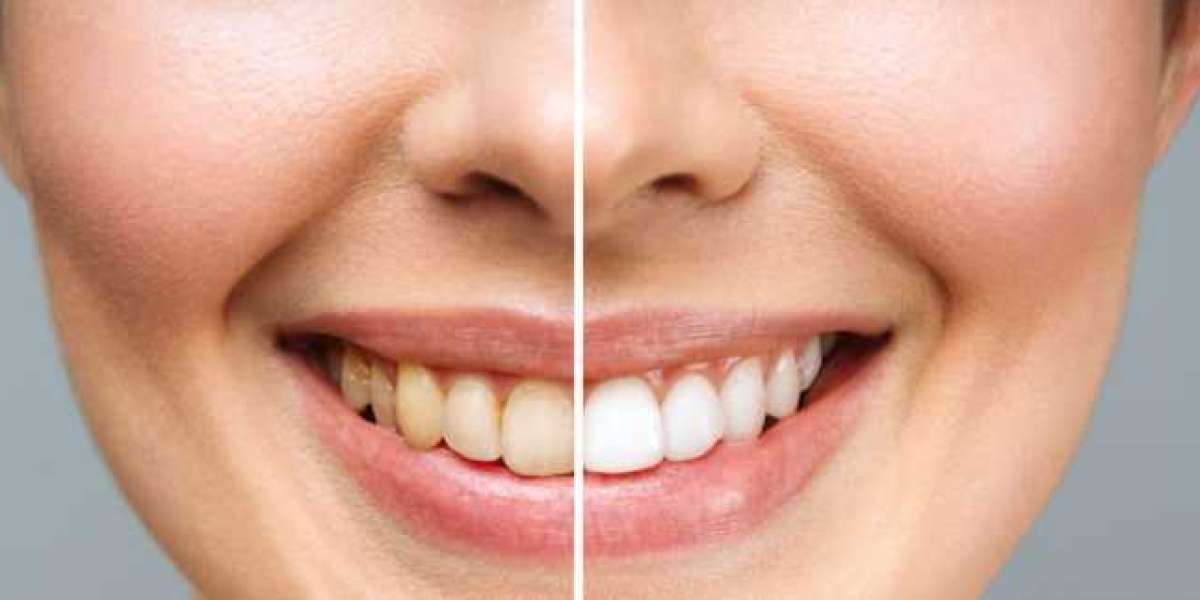 The Best Teeth Whitening Experience in Toronto | Only at Dentistry in the Beach