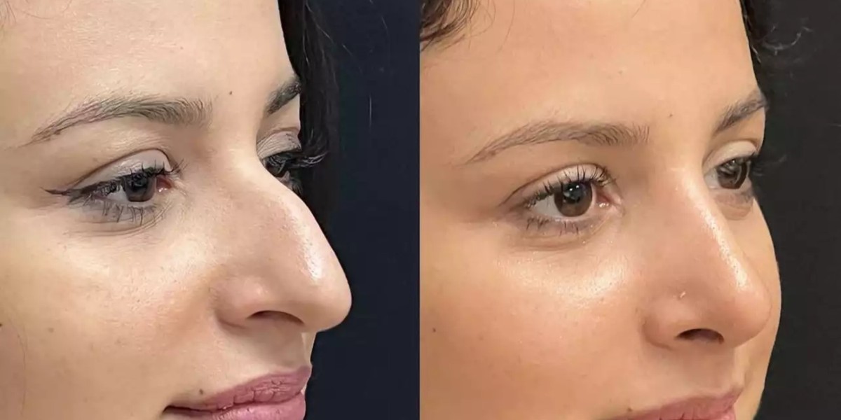 Rhinoplasty in Dubai: Combining Art and Aesthetic Science