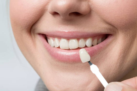 How Dental Veneers Improve Your Confidence and Appearance