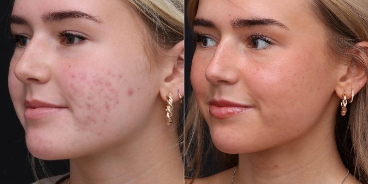 Can You Get Rid of Acne Scars Without Laser?
