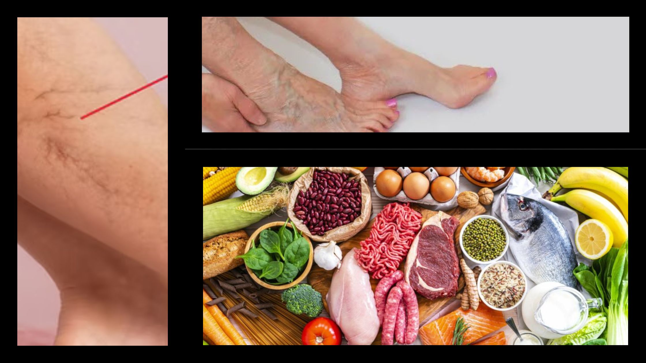 Natural Remedies to Treat Varicose Veins – Elite Vascular
