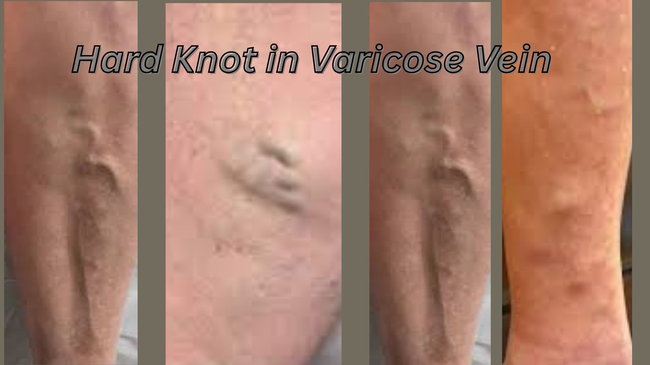 Hard Knot in Varicose Vein: Causes, Symptoms, and Treatment Options – Elite Vascular