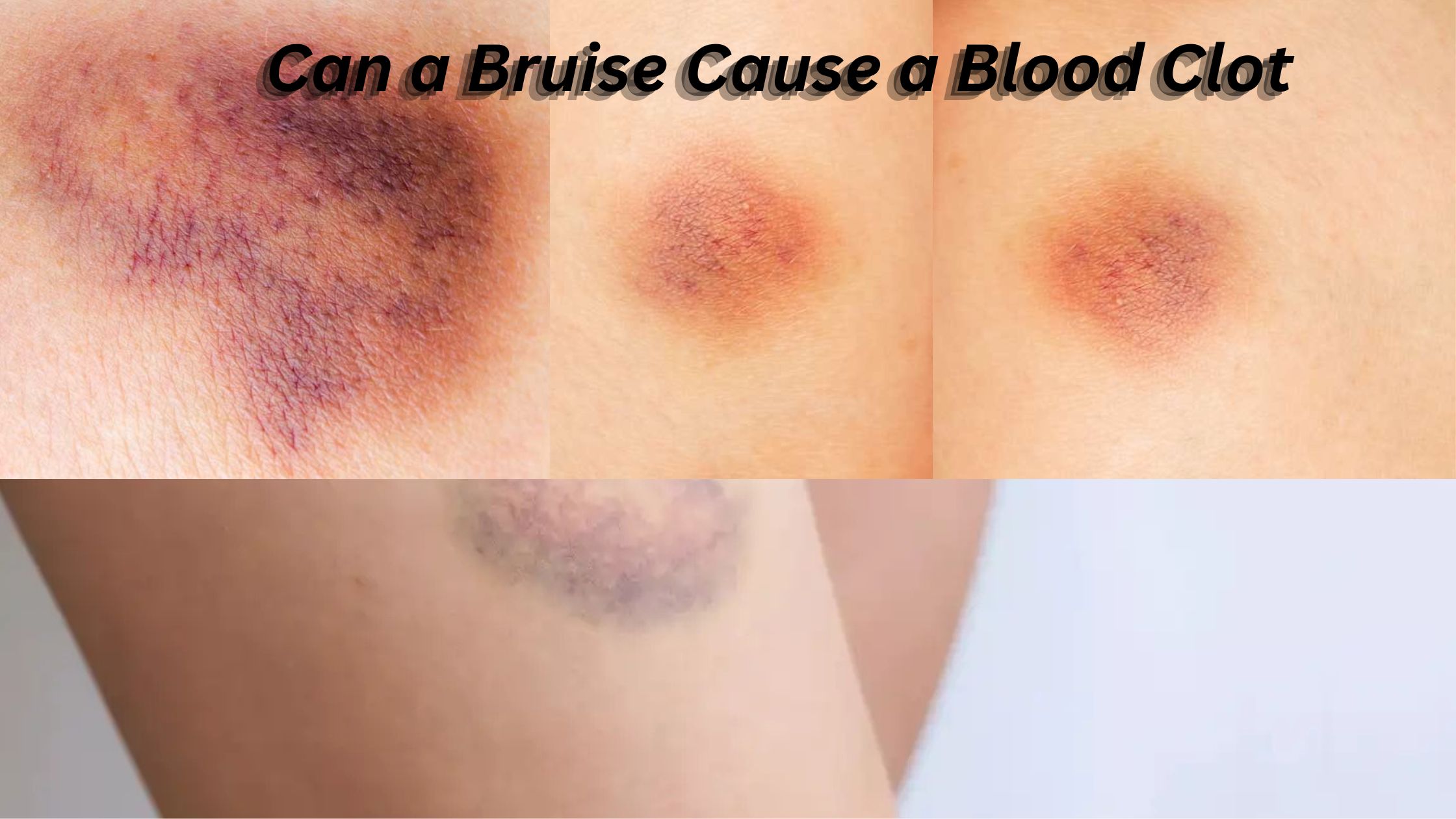 Can a Bruise Cause a Blood Clot – Elite Vascular
