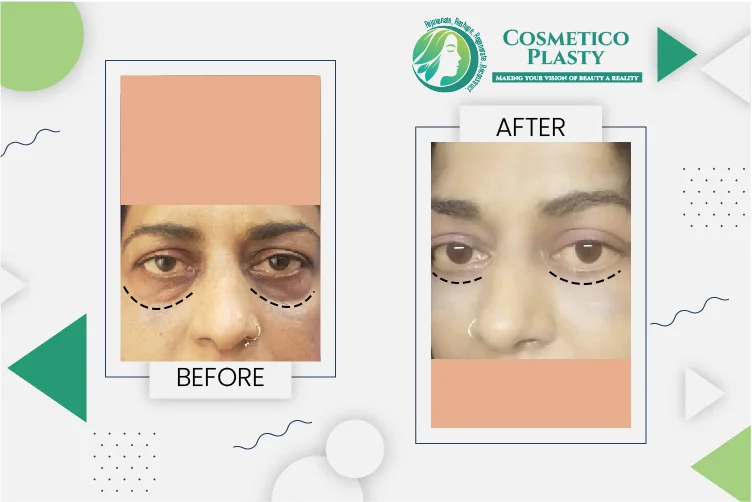 Top Clinics for Eyelid Surgery in Lahore: A Guide for Patients – Cosmeticoplasty