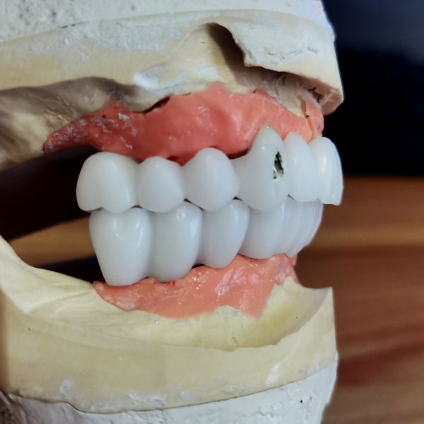 Dental Implant Service | Blue Sky Dental Lab