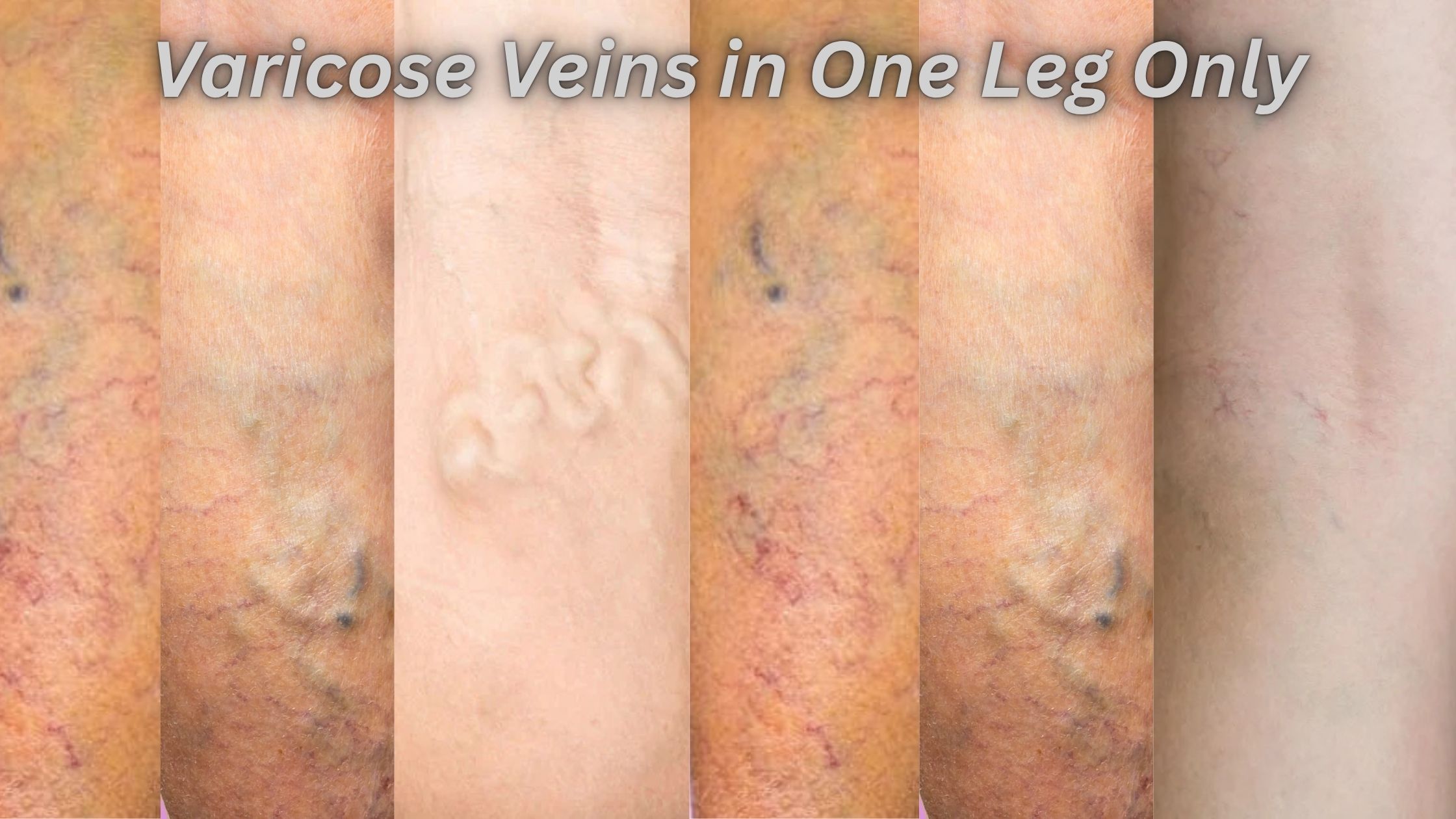 Varicose Veins in One Leg Only: Causes, Symptoms and Treatment – Elite Vascular