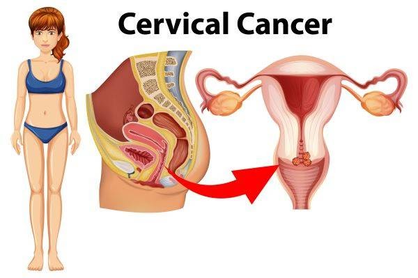 Is Cervical Cancer Preventable? Here’s What You Need to Know in 2025
