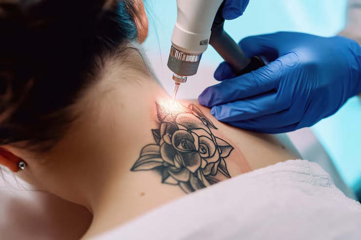 Tattoo Laser Treatment: What It Is, Safety, and Who Gets It? - Amora Skin & Beauty
