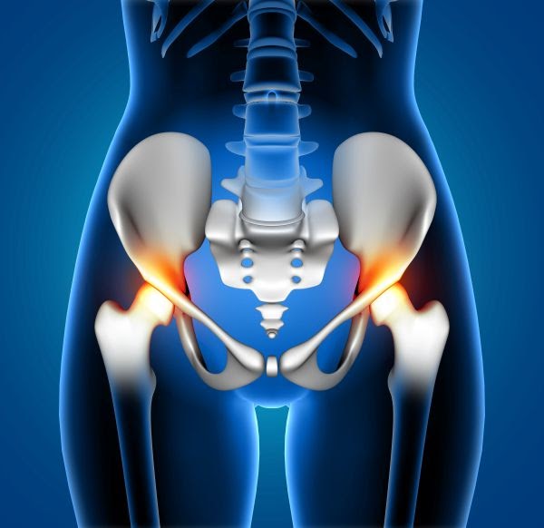 Foods That Speed Up Healing After Hip Replacement Surgery