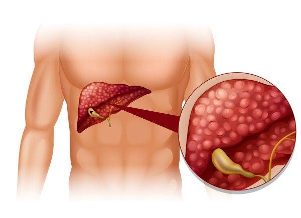 Gall Bladder Cancer vs. Gallstones: Key Differences You Need to Know