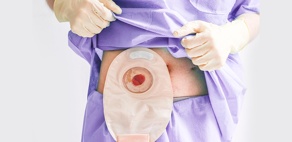 How to Change a Colostomy Bag at Home - Step-by-Step Guide for Crohn’s Patients