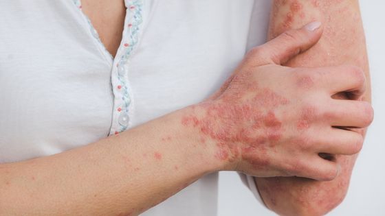 Is Psoriasis Genetic? What are Its Causes and Treatment Options?