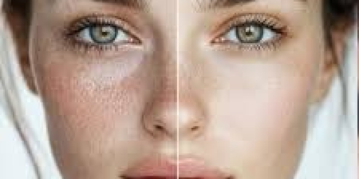 Melasma Treatment in Islamabad: What You Need to Know