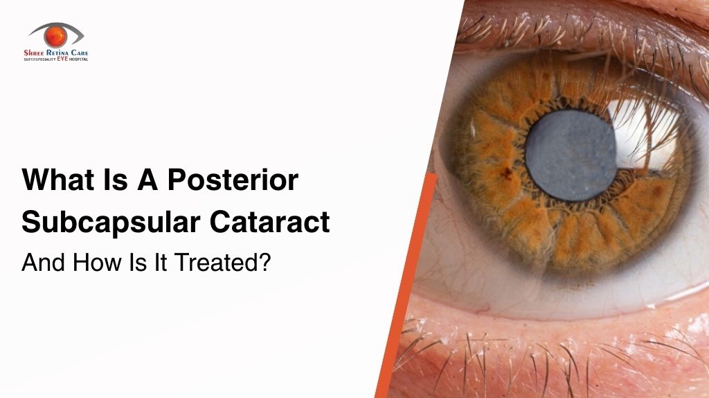 What Is a Posterior Subcapsular Cataract and How Is It Treated?