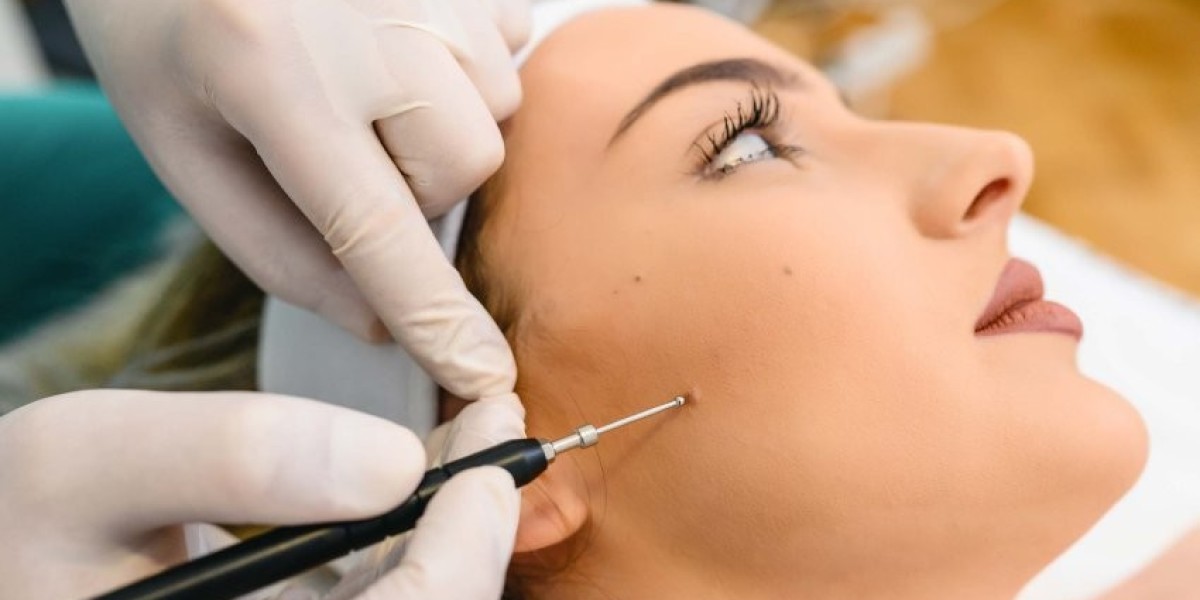 Top Mole Removal Treatment Options: Laser, Surgery, and More