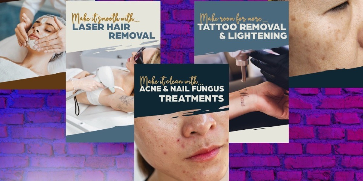Laser Tattoo Removal in Sartell