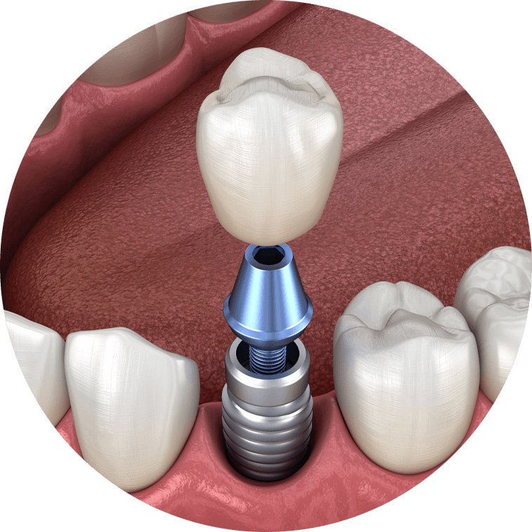 Dental Implants in Jaipur | FaceKraft Dental Implant Clinic
