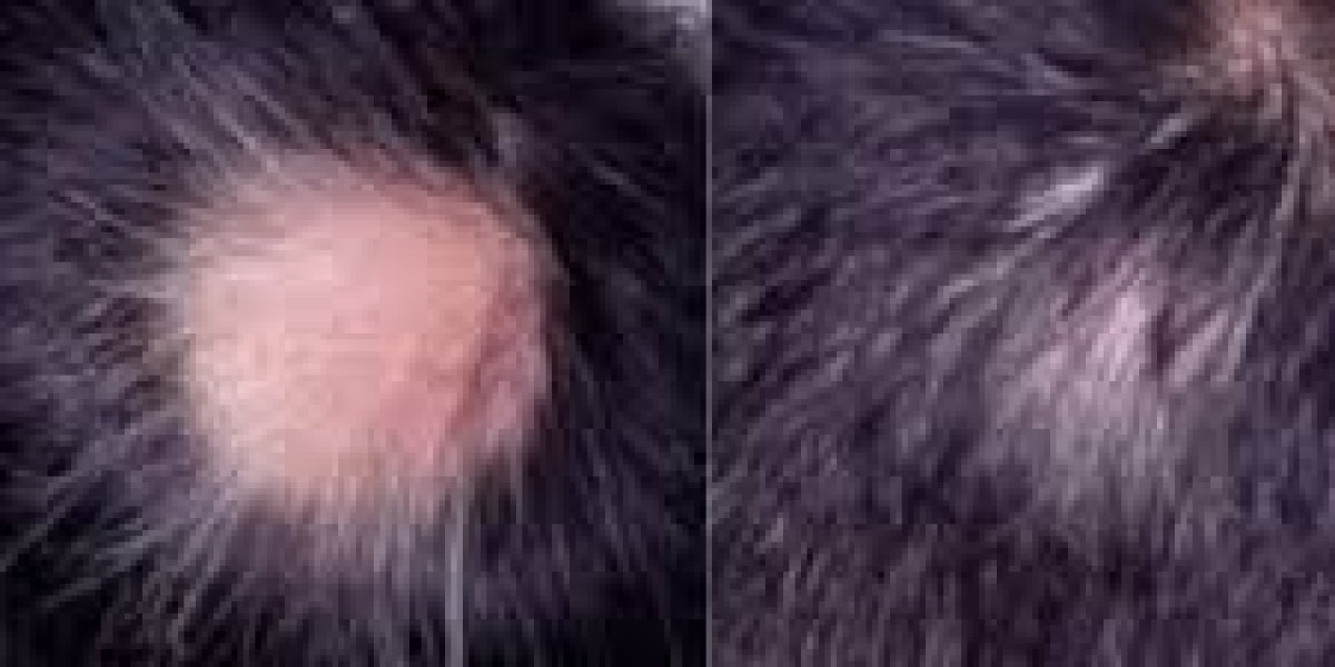 Alopecia Areata Treatment in Islamabad – Advanced Solutions for Hair Loss
