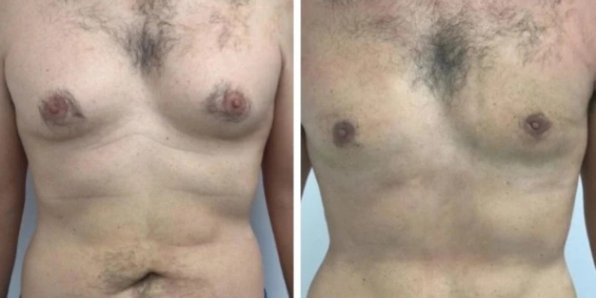 Why Expertise Matters When Choosing the Best Gynecomastia Surgeon in Dubai