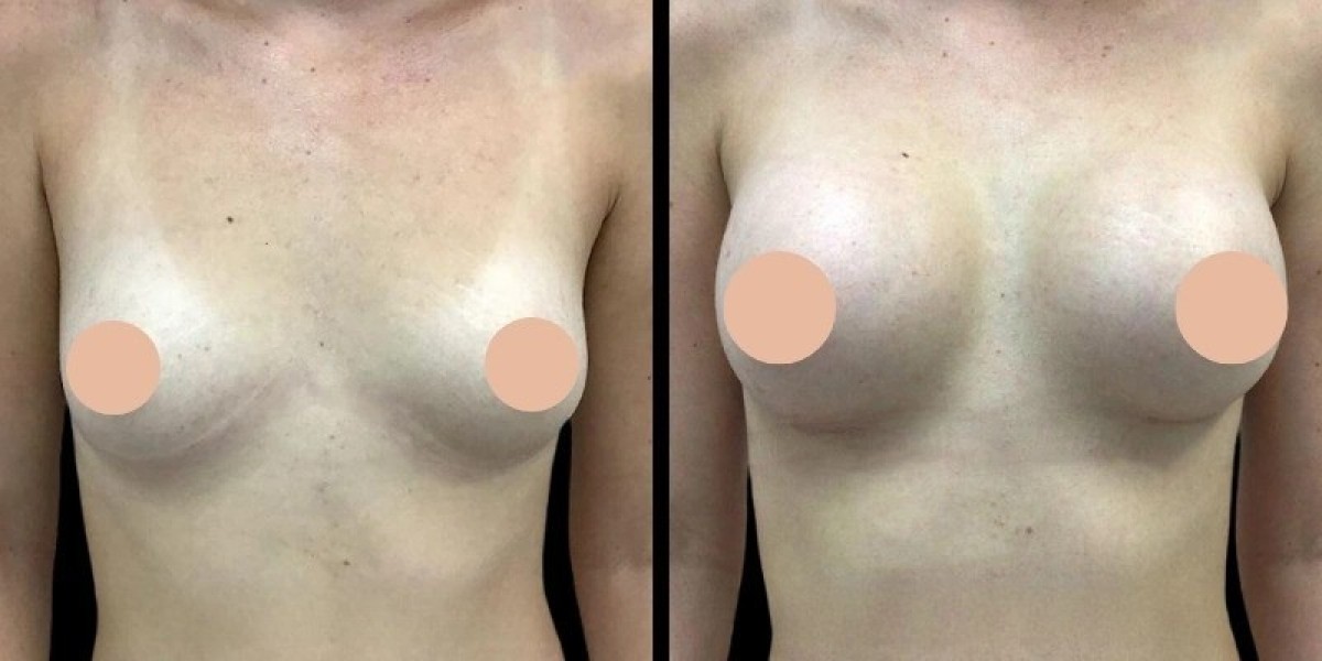 Best Breast Augmentation Surgeons in Dubai: Durable Enhancement Results