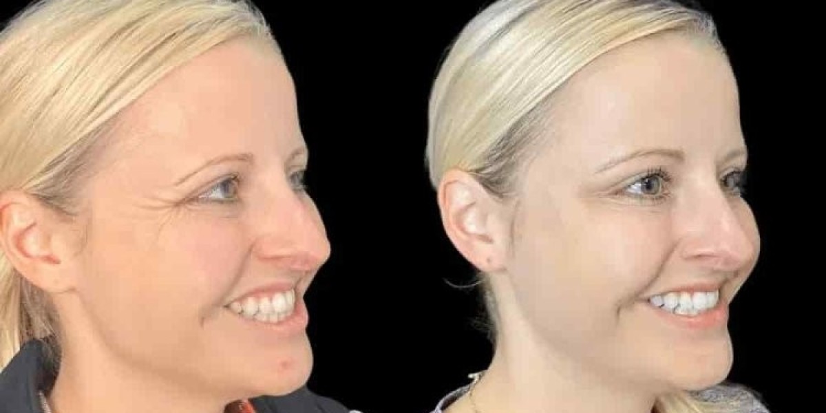 Botox in Dubai with Comprehensive Aesthetic Support