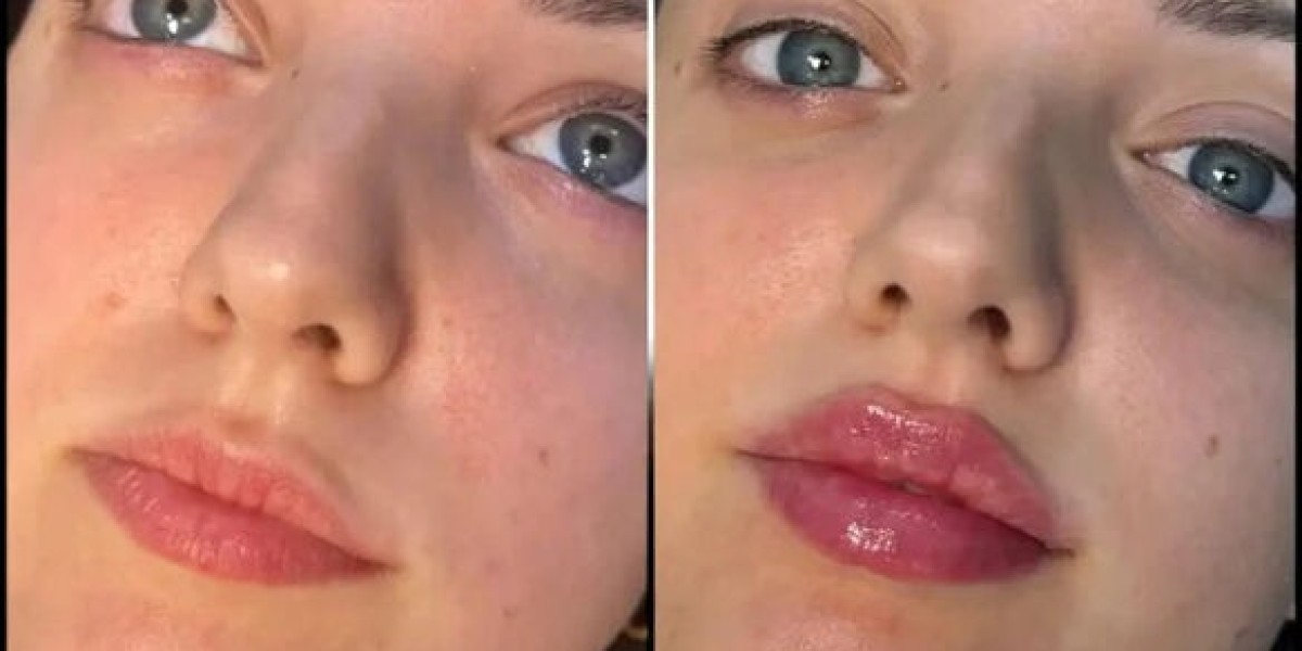 Elevate Your Confidence with the Best Plastic Surgeon in Dubai for Fillers
