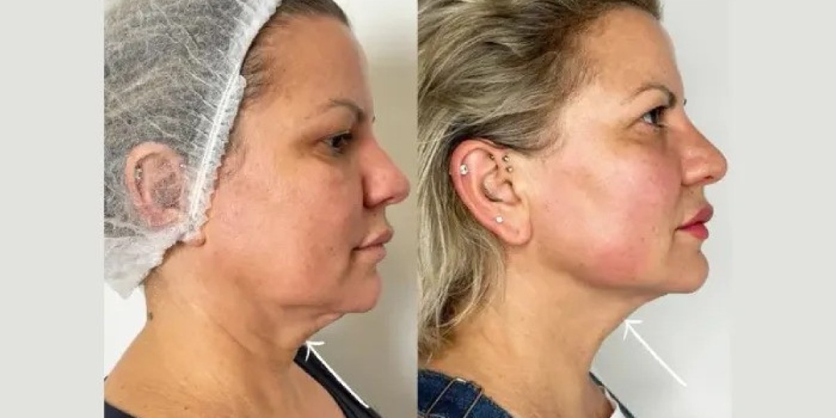Best Plastic Surgeons in dubai Offering Professional Endolift Skin Solutions