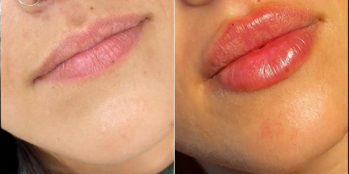 Top Reasons to Visit the Best Aesthetic Clinics in Dubai for Fillers