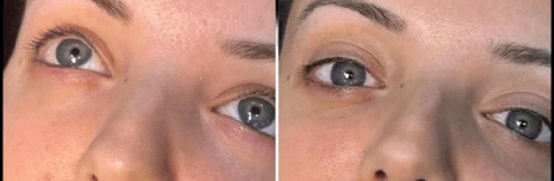 dermal fillers Cover Image
