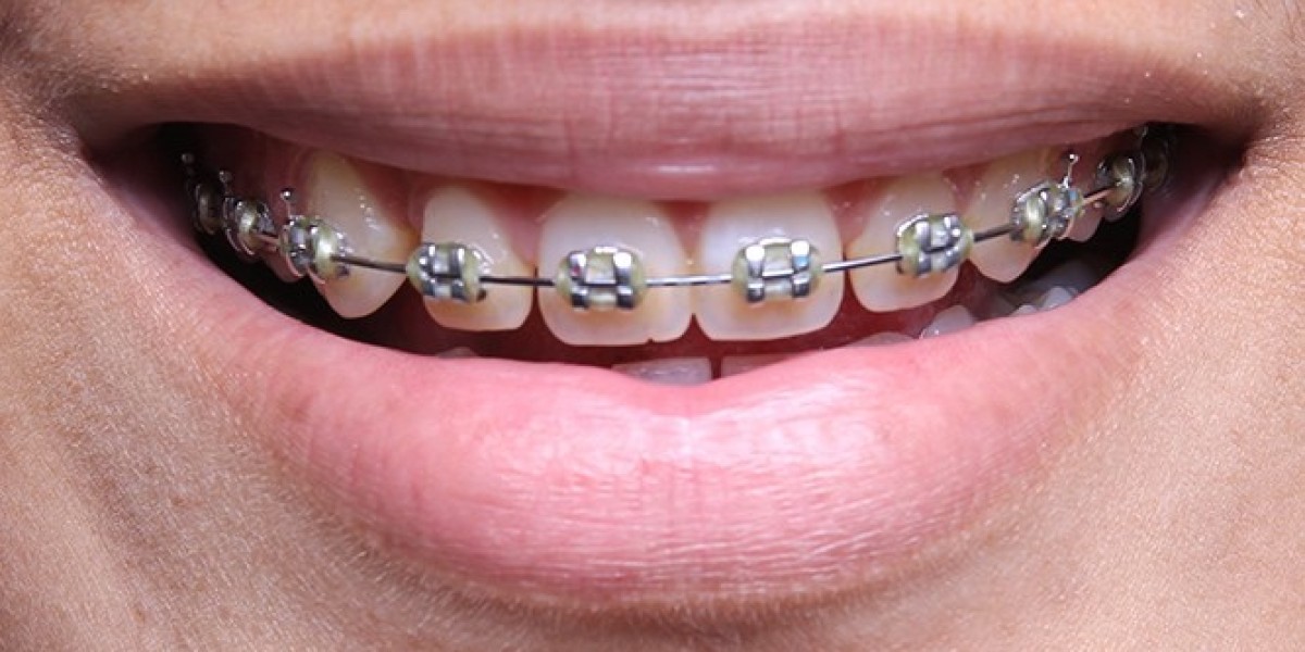 What Are the Benefits of Damon Braces in Dubai?