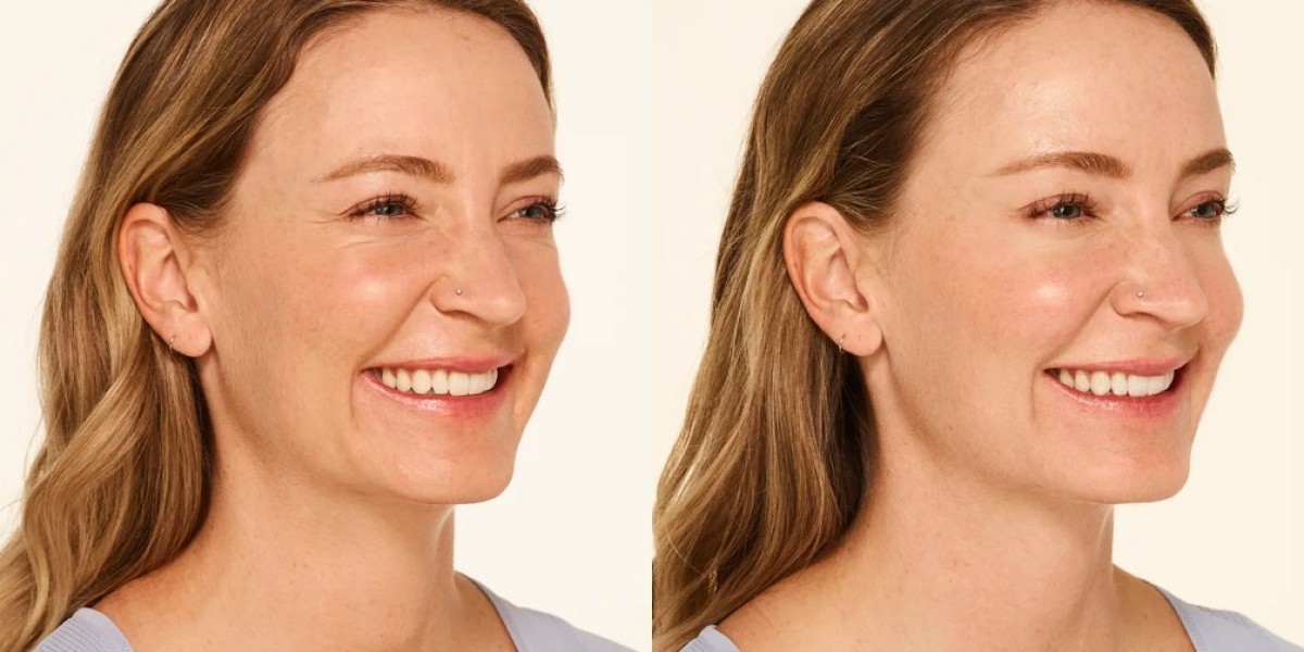 Botox Near Me: Why More People in Shelton, CT Are Choosing Professional Aesthetic Treatments