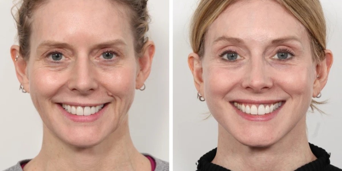 Thread Lift Treatments in Dubai with Advanced Techniques