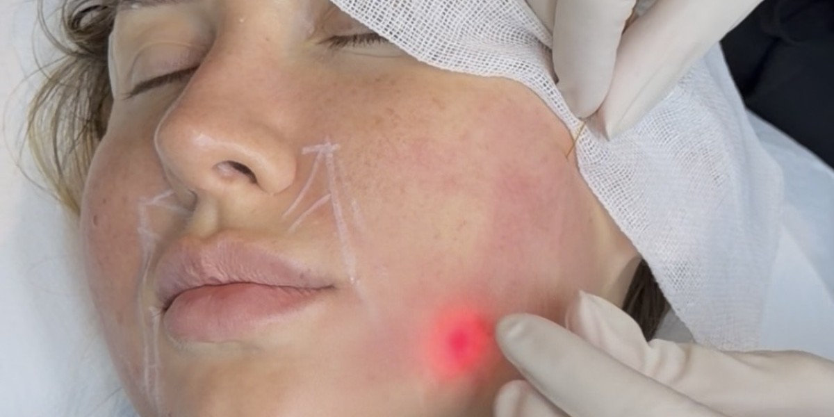 Endolift Dubai Cost: Is This Non-Surgical Facelift Really Worth Your Money?