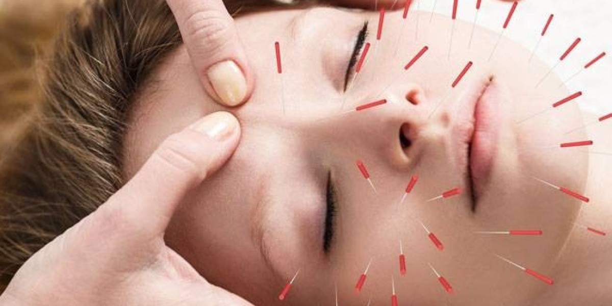Acupuncture: An Ancient Path to Modern Healing