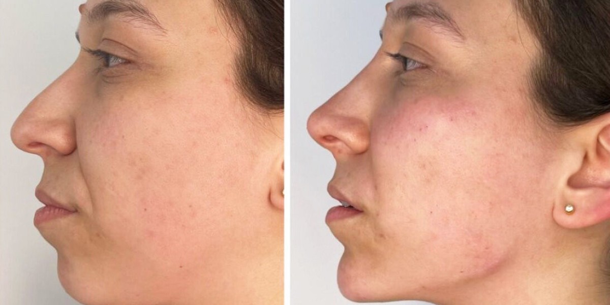 Endolift Laser Dubai: The Skin Tightening Treatment That Doesn’t Ask You to Put Your Life on Hold
